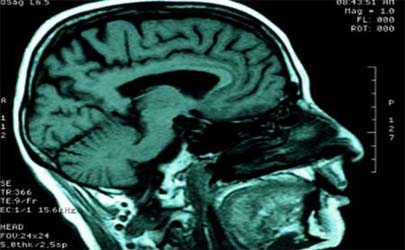 ضربه مغزی خفیف به بیماری‌های عصبی مانند زوال عقل مبتلا می شوند