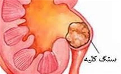 چه کنیم تا سنگ کلیه نگیریم